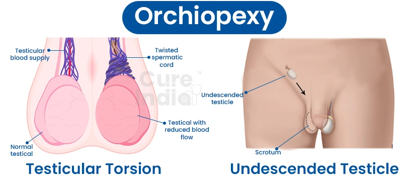 Orchiopexy Surgery in India